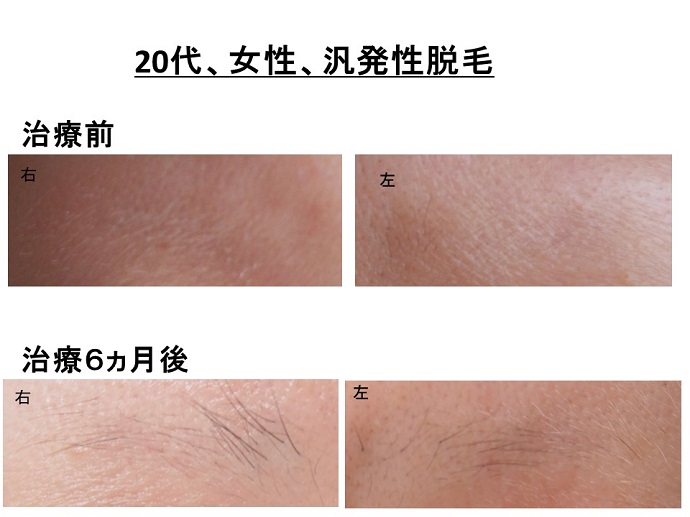 円形脱毛症　病院